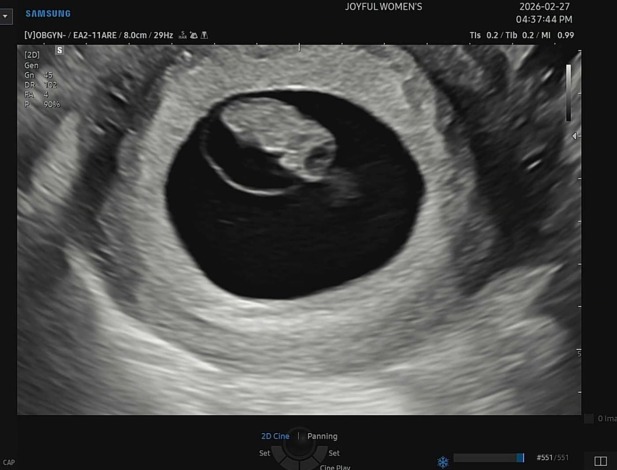 두콩이 7주차 초음파