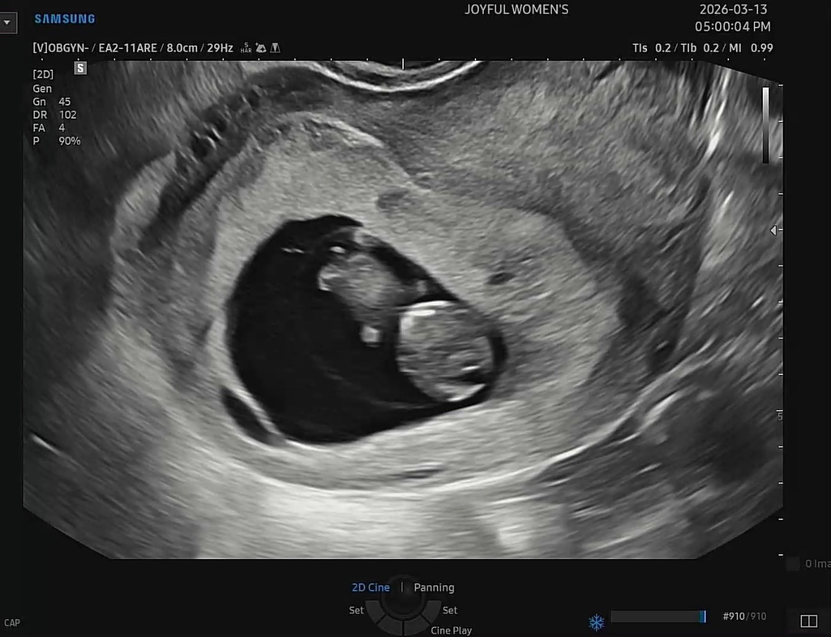 두콩이 초음파 사진